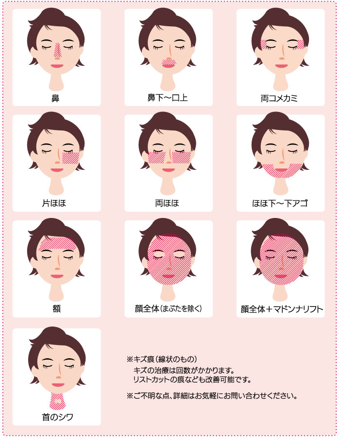 スマートサイドドット 施術範囲