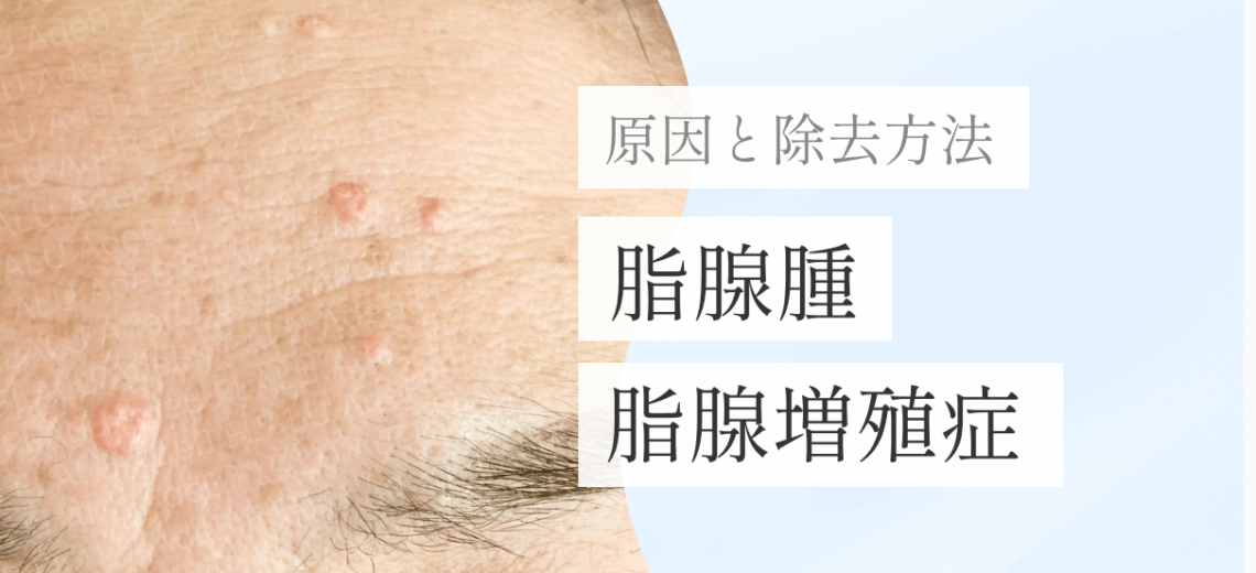 浜松町皮膚科_MV_脂腺腫（脂腺増殖症）の原因と除去_251227