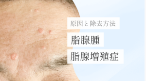 浜松町皮膚科_MV_脂腺腫（脂腺増殖症）の原因と除去_251227