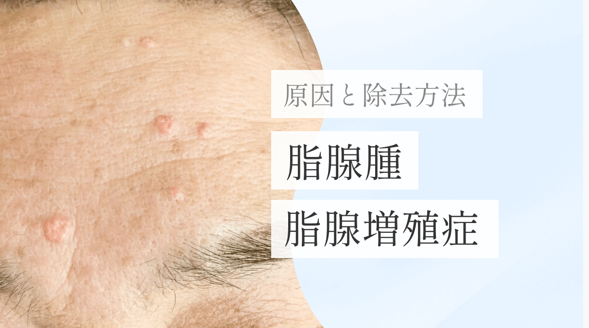 浜松町皮膚科_MV_脂腺腫（脂腺増殖症）の原因と除去_251227