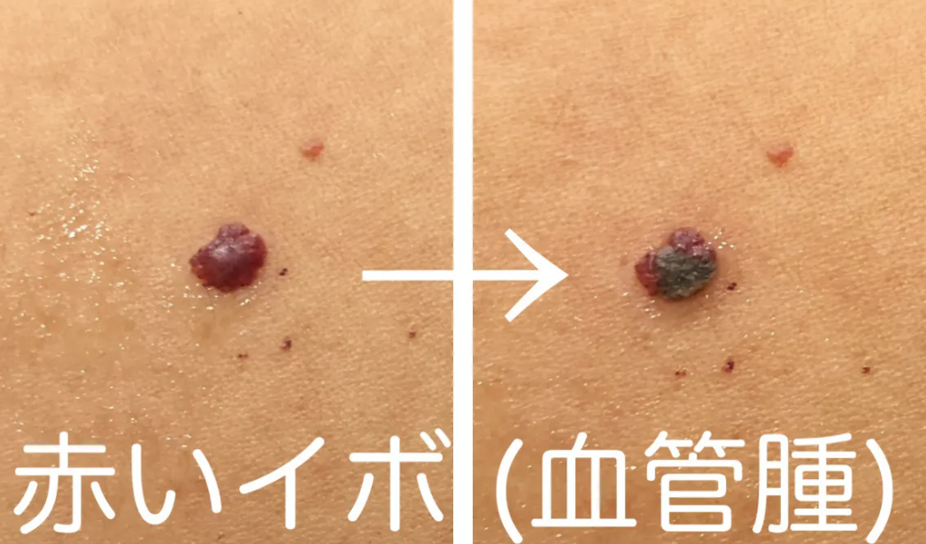 血管腫の治療経過