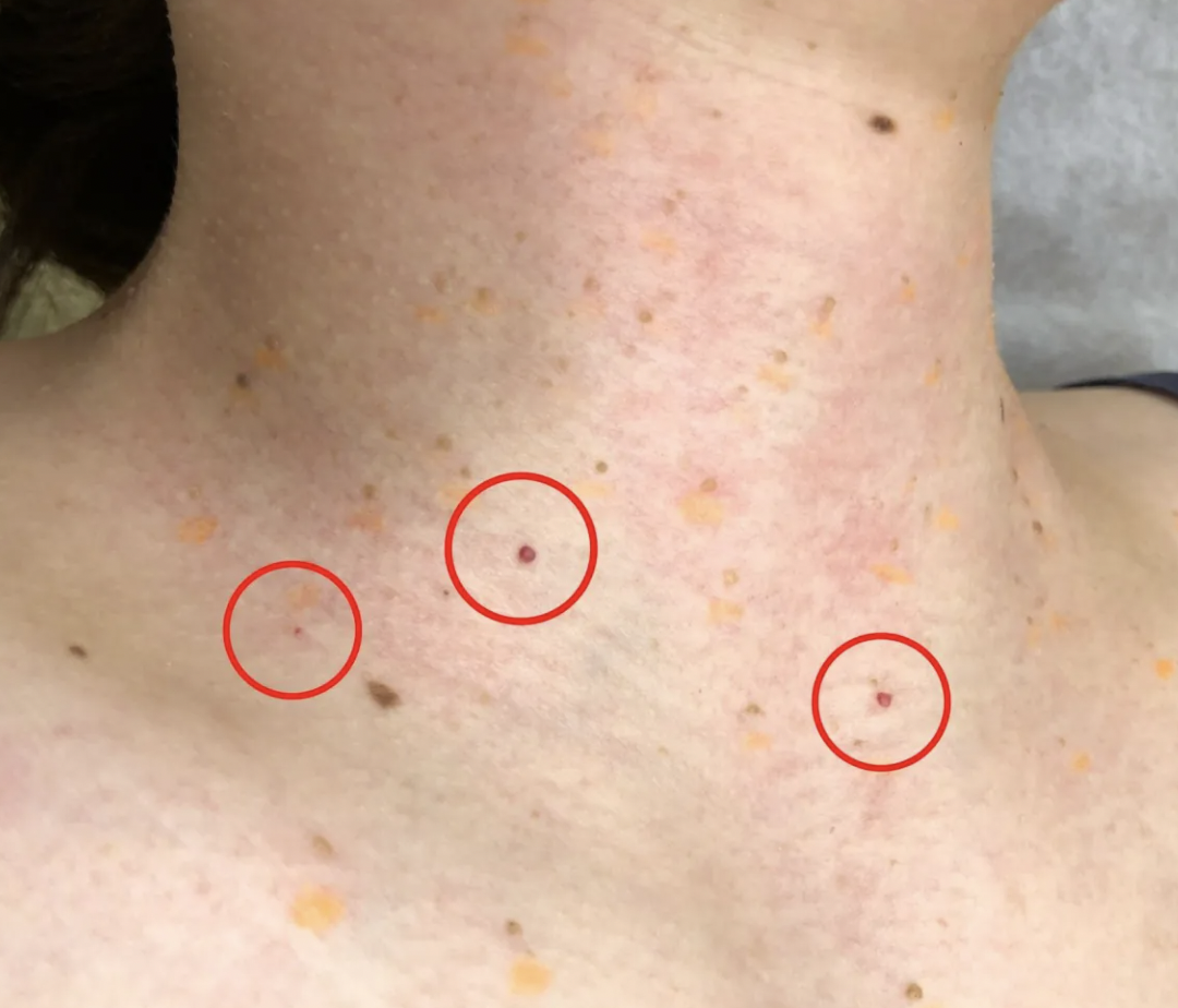 赤いぽつぽつ血管腫