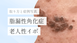 浜松町皮膚科_脂漏性角化症_251228